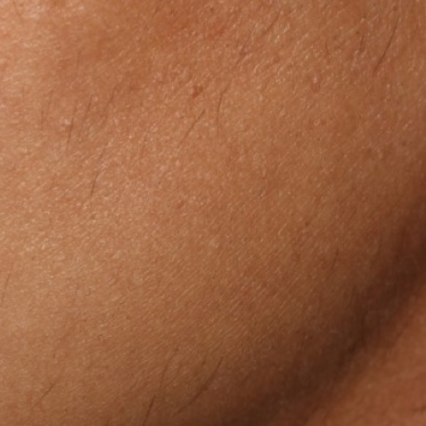 c2_ba_extra_fine_hair_removal_after