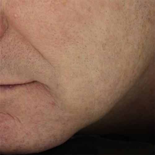 murgiamouthaftertx2-3