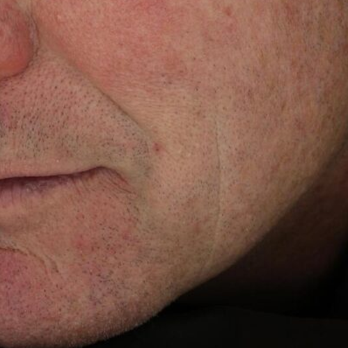 murgiamouthbeforetx2-1