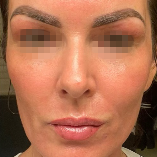 eco2-fine-fittings-med-spa-2-after-1