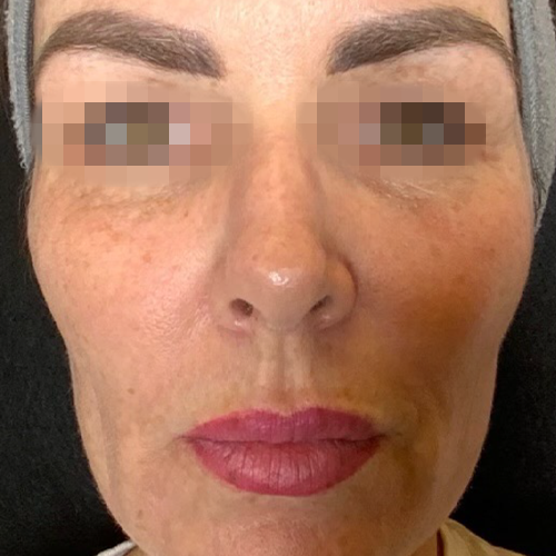 eco2-fine-fittings-med-spa-2-before-1_